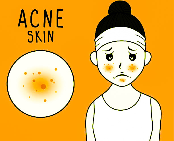 Acne Symptoms