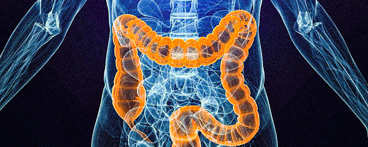 What is Colon Cancer - Symptoms, Causes, Diagnosis and Treatment