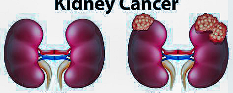 Everything About  Kidney Cancer? Symptoms, Causes, Prevention and Treatment
