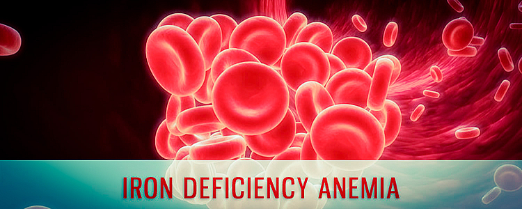 What is Iron Deficiency Anemia, Sign & Symptoms, Causes, Diagnosis, and Treatment?