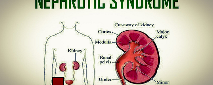 What is Nephrotic Syndrome, Signs & Symptoms, Causes, Diagnosis, and Treatment?