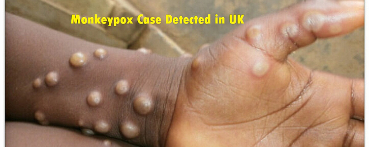 What is Monkeypox, Symptoms, Spread, Prevention, Treatment