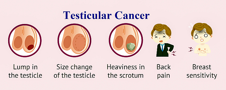 What is Testicular Cancer, Its Symptoms, Causes, Diagnosis, and Treatment